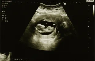 Ultrasound of baby at 12 weeks. Credit: arhendrix/Shutterstock